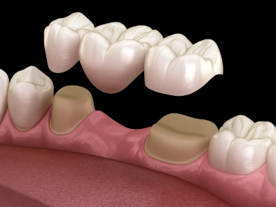Dental Crowns