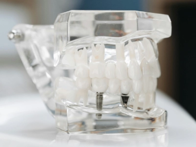 Dental Implants